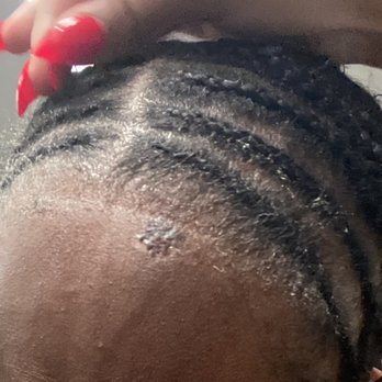 Studio Chique - Scabs and dent that went all around my scalp under the weave. I still had dents after a whole week of this sew in - Hair Salons Near Me - Washington, DC, District of Columbia Studio Chique - Scabs and dent that went all around my scalp under the weave. I still had dents after a whole week of this sew in - Hair Salons Near Me - Washington, DC, District of Columbia