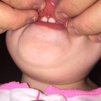 Kenneth R Levine, DDS - This is upper lip tie reattachment. Exactly the opposite of what Dr. Kenneth Levine told us. - Periodontists Near Me - Tamarac, Florida