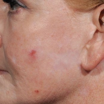 Rod Rohrich, MD - SCARRING FROM DR. ROHRICH INJECTING FAT WHEN I TOLD HIM NO FAT. ALSO HE RUINED MY EARLOBES BY INJECTING FAT INTO THEM. HE DID ALL W/O PERMIS - Plastic Surgeons Near Me - Dallas, Texas Rod Rohrich, MD - SCARRING FROM DR. ROHRICH INJECTING FAT WHEN I TOLD HIM NO FAT. ALSO HE RUINED MY EARLOBES BY INJECTING FAT INTO THEM. HE DID ALL W/O PERMIS - Plastic Surgeons Near Me - Dallas, Texas