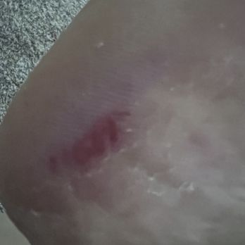Ranch Nails Spa - Cut on my heel when they did callus removal. - Nail Salons Near Me - Ontario, California Ranch Nails Spa - Cut on my heel when they did callus removal. - Nail Salons Near Me - Ontario, California