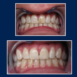 Kingwood Family & Cosmetic Dentistry - Discolored tooth bothered this young man for a long time. Composite bonding restored his smile.