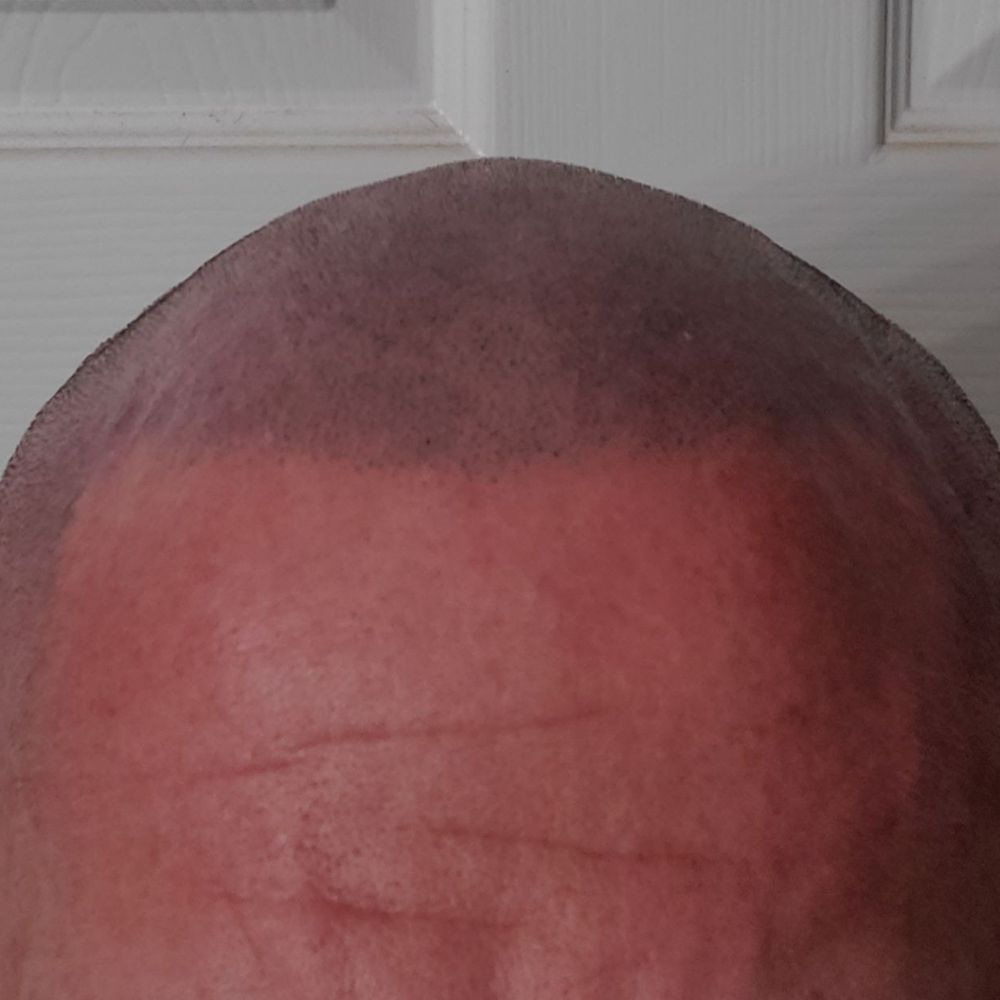 SMP INK - After - Hair Loss Centers Near Me - Las Vegas, Nevada SMP INK - After - Hair Loss Centers Near Me - Las Vegas, Nevada
