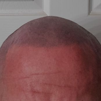 SMP INK - After - Hair Loss Centers Near Me - Las Vegas, Nevada