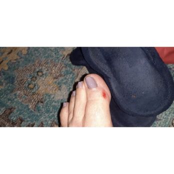 V Nail Salon - My poor friends toe after being rubbed too hard with a callous remover! And she said ouch and pulled away! Terrible! - Nail Salons Near Me - Vista, California V Nail Salon - My poor friends toe after being rubbed too hard with a callous remover! And she said ouch and pulled away! Terrible! - Nail Salons Near Me - Vista, California