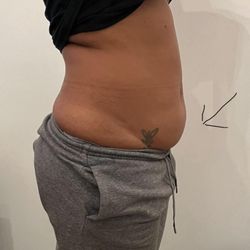 Sculpt Body Contouring & More - Before