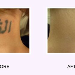 Abington Aesthetic & Laser Medical Center - Tattoo removal
