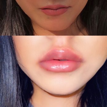 Spa Black - My lips - Medical Spas Near Me - San Antonio, Texas