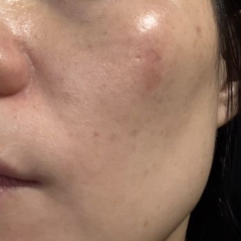 Radiant Med Spa - After - Laser Hair Removal Near Me - Fremont, California Radiant Med Spa - After - Laser Hair Removal Near Me - Fremont, California