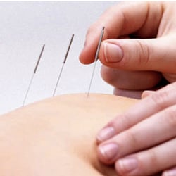 Massage Therapy Center Palo Alto - Licensed acupuncturist providing traditional Chinese acupuncture treatment to complement massage therapy. Best in Palo Alto and San Jose.