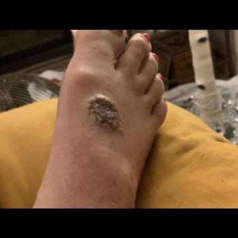 Innovative Dermatology and Mohs Surgery - After Moh's surgery after Dr Kontos surgery and skin graft. Still painful and can't walk without pain a year and a half later. - Dermatologists Near Me - Lehigh Acres, Florida