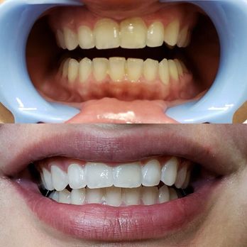 Lip Lab Az - Stunning Results She's Hooked already booked her next sesh!!! - Teeth Whitening Near Me - Mesa, Arizona