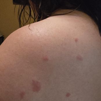 Best Western Cedar Inn - Bites that weren't there when I went to bed, for what it's worth - both sides and my hands - Hotels Near Me - Cedar Park, Texas