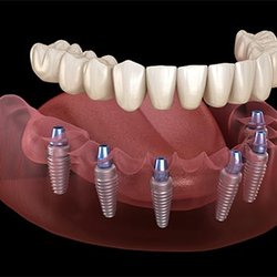 Ideal Dental Care