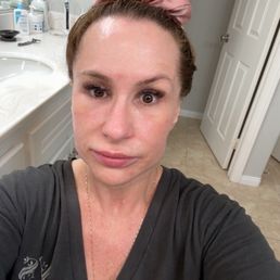 Bad Botox Bad Botox