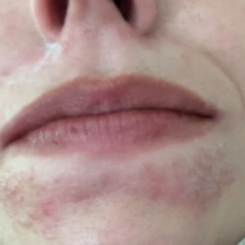 Connecticut Dermatology Group - After treatment at this dermatology clinic ; obviously didn't work - Dermatologists Near Me - Norwalk, Connecticut