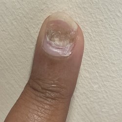 Luxury Nail Spa - Nail bed after acrylic came off