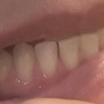 Ocean Breeze Dental - Gap between teeth caused by electric tool being stuck - General Dentistry Near Me - Rockledge, Florida Ocean Breeze Dental - Gap between teeth caused by electric tool being stuck - General Dentistry Near Me - Rockledge, Florida