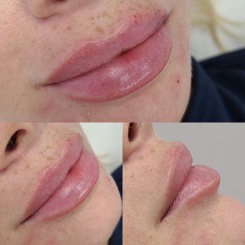 Selfie Aesthetic - Lips - Medical Spas Near Me - Coral Gables, Florida Selfie Aesthetic - Lips - Medical Spas Near Me - Coral Gables, Florida