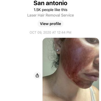 Cosmetic Laser Center - This was the a few night after the treatment. My skin eventually began to crack and bleed - Medical Spas Near Me - San Antonio, Texas Cosmetic Laser Center - This was the a few night after the treatment. My skin eventually began to crack and bleed - Medical Spas Near Me - San Antonio, Texas