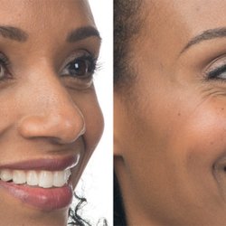 Contour Dermatology & Cosmetic Surgery Center - Botox for Crow's Feet, 7 days after treatment.