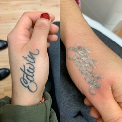 Sollay Laser Center - After one treatment of laser tattoo removal!