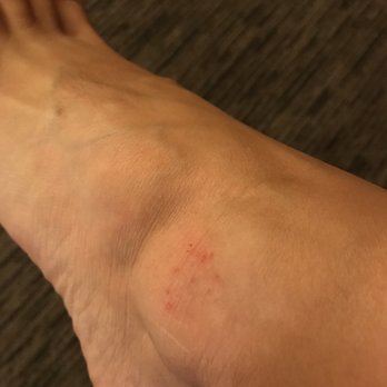 Bellaggio Nail and Spa - On my ankle is the itchy rash...????? Also feels like I'm getting one on the top of my foot. - Nail Salons Near Me - Indio, California Bellaggio Nail and Spa - On my ankle is the itchy rash...????? Also feels like I'm getting one on the top of my foot. - Nail Salons Near Me - Indio, California