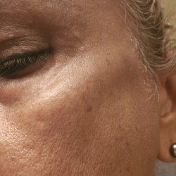 This is how swollen and bruised my face is after 3 weeks.