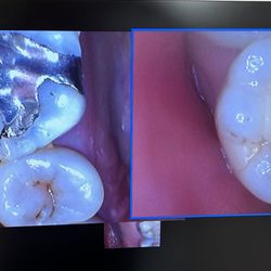 Linh M Cao-Chan,DDS - Digital camera can take closeup photos of teeth for better diagnosis