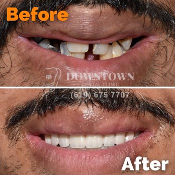 Downtown Dental Tijuana - All on 4 Procedures, Fixed Dentures Over Implants - Cosmetic Dentists Near Me - Tijuana, BCN Downtown Dental Tijuana - All on 4 Procedures, Fixed Dentures Over Implants - Cosmetic Dentists Near Me - Tijuana, BCN
