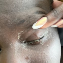 Tammy's Eyebrow Spa - Eyes glued shut the morning after removing the lashes.