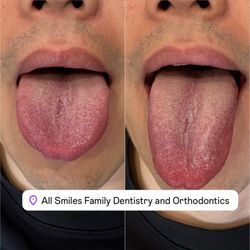 All Smiles Family Dentistry and Orthodontics - Lingual frenectomy tongue release done by Dr. Annie! Total time: 10 mins