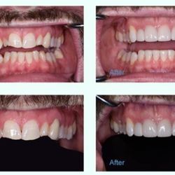 Portneuf Valley Dental - Before and after photos