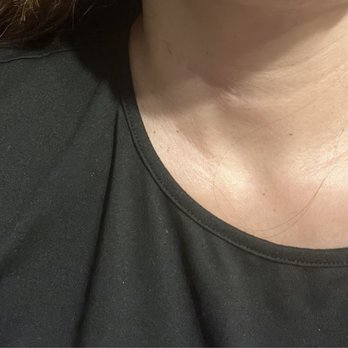 Kapil Moza, MD - 1 year postop. Still healing nicely. - Neurologist Near Me - Agoura Hills, California Kapil Moza, MD - 1 year postop. Still healing nicely. - Neurologist Near Me - Agoura Hills, California