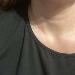 Kapil Moza, MD - 1 year postop. Still healing nicely.