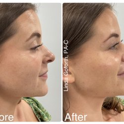 The Aesthetic Center - Before and immediately after jawline, chin, cheek, and lip enhancement with dermal fillers.