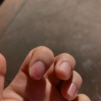 Pearl Nails - cut and nail bed damage from acrylic nail removal. - Nail Salons Near Me - Rosemead, California Pearl Nails - cut and nail bed damage from acrylic nail removal. - Nail Salons Near Me - Rosemead, California
