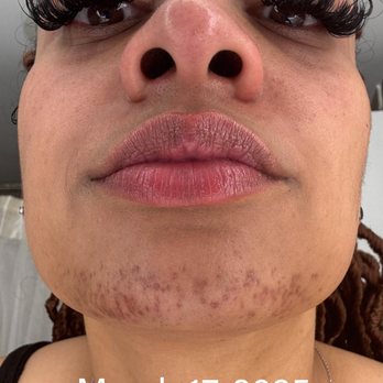 Restoration Electrolysis - Hair Removal Near Me - Pittsford, New York