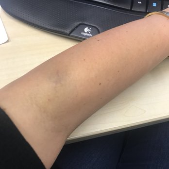 Hangover Heaven - Large bruise near the IV site and down my forearm. This is the arm that was used. - IV Hydration Near Me - Las Vegas, Nevada Hangover Heaven - Large bruise near the IV site and down my forearm. This is the arm that was used. - IV Hydration Near Me - Las Vegas, Nevada