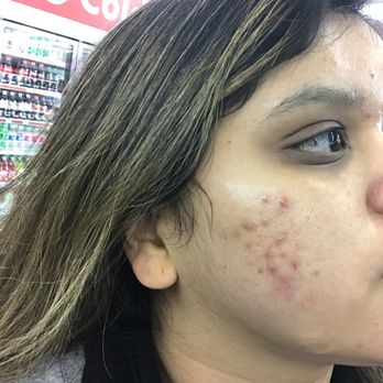 clear beauty acne clinic