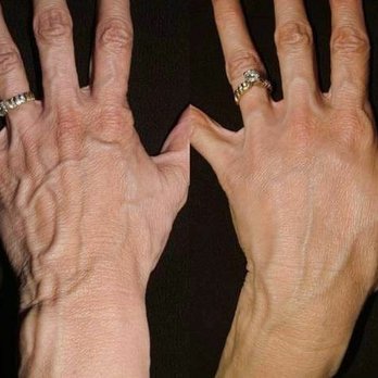 AlecXander Medical Spa - Are your hands giving away your age? Filler can be injected to give your hands a more youthful look and can last up to 2 years! - Skin Care Near Me - Hurst, Texas AlecXander Medical Spa - Are your hands giving away your age? Filler can be injected to give your hands a more youthful look and can last up to 2 years! - Skin Care Near Me - Hurst, Texas