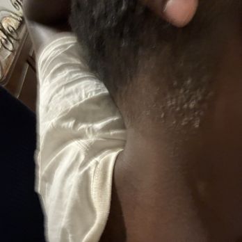 Empire Hair Studio - Razor Bumps and Staph Infection - Barbers Near Me - Philadelphia, Pennsylvania Empire Hair Studio - Razor Bumps and Staph Infection - Barbers Near Me - Philadelphia, Pennsylvania
