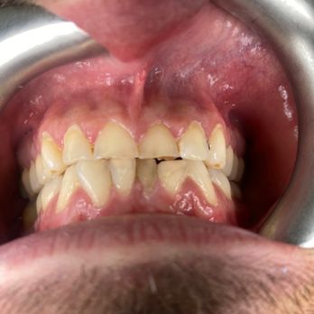 Lifetime Dental Care - Before - Cosmetic Dentists Near Me - Woodbridge, Virginia Lifetime Dental Care - Before - Cosmetic Dentists Near Me - Woodbridge, Virginia