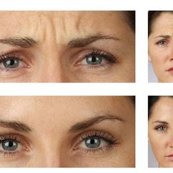 Spa Three Ten - We offer Botox services at Spa310