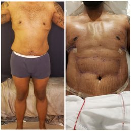 Day before surgery...& 1 day after