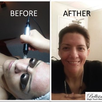 Bellisima Magic Touch Spa - Micro-needle Treatment - Day Spas Near Me - Miami, Florida Bellisima Magic Touch Spa - Micro-needle Treatment - Day Spas Near Me - Miami, Florida