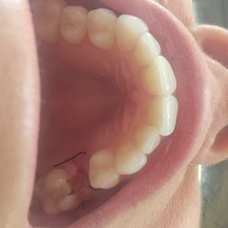 Bright Now Dental & Orthodontics - Clearwater - clean stitches!
