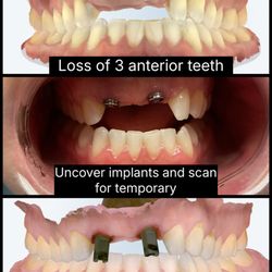René A Talbot, DDS - Implant Restorations