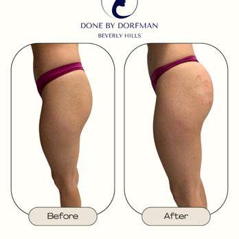 Robert Dorfman, MD - Hourglass Shot (Non-Surgical BBL) to add subtle volume and enhancing the overall shape! Our patient was happy with the natural results. - Cosmetic Surgeons Near Me - Beverly Hills, California Robert Dorfman, MD - Hourglass Shot (Non-Surgical BBL) to add subtle volume and enhancing the overall shape! Our patient was happy with the natural results. - Cosmetic Surgeons Near Me - Beverly Hills, California