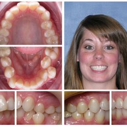 Upper Dublin Family Dentistry - Invisalign case