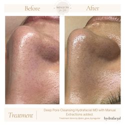 SkinGlow Skin Studio - Before and after Hydrafacial Treatment and Extractions